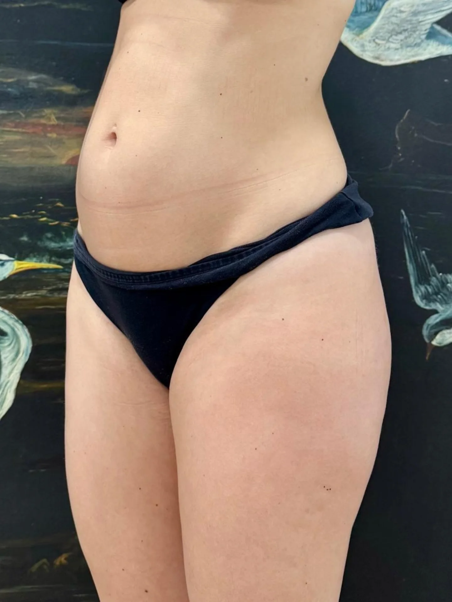 Silhouette Liposuction Before